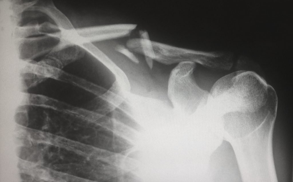 xray of shoulder area